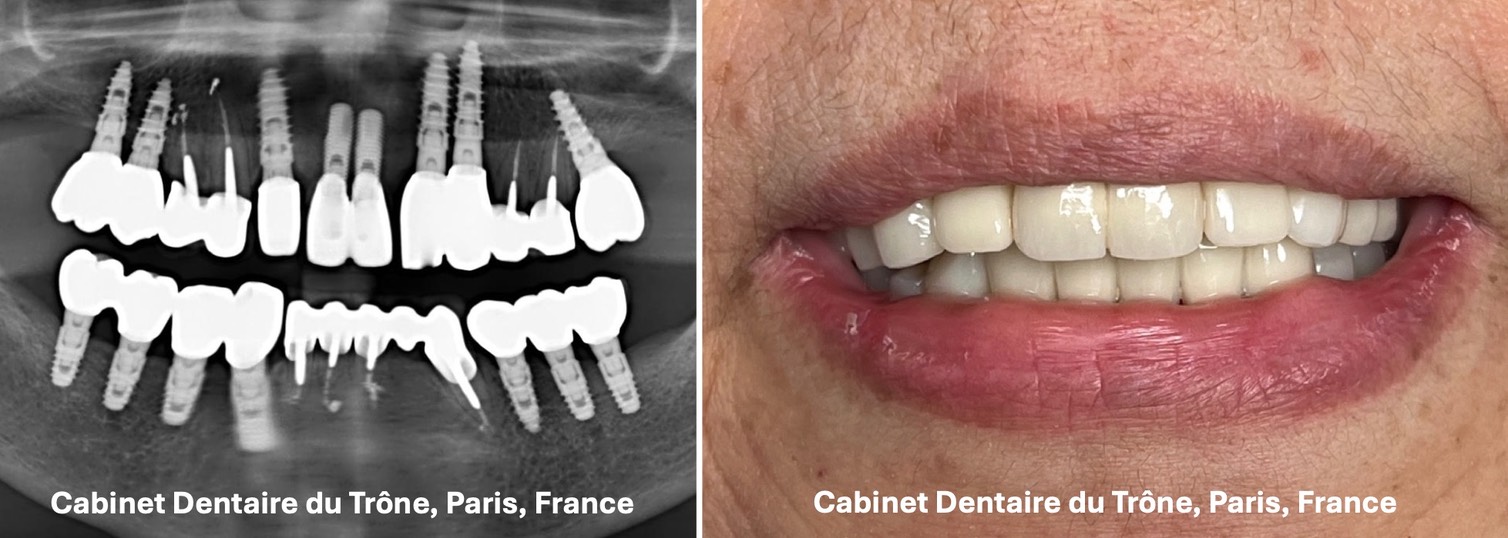 Montage implants sourire