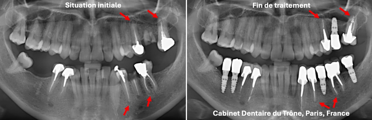 Montage rehab complexe